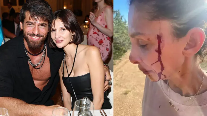 Can Yaman'ın sevgilisi, kanlar içinde paylaşım yaptı: Çocuğumun babasından şiddet görüyorum